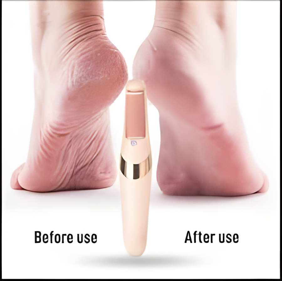 Electric Foot Callus Remover Tool – Electronic File for Dead Skin & Hard Tissue